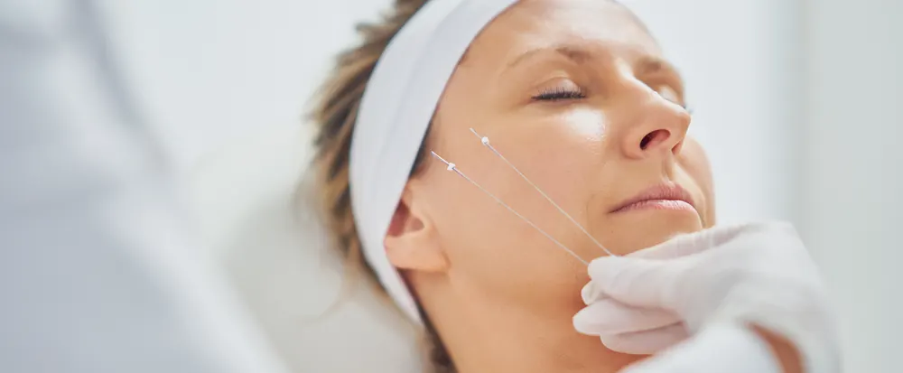 Provider placing PDO threads along a client's cheek